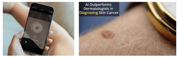 AI Diagnosing Skin Cancer
